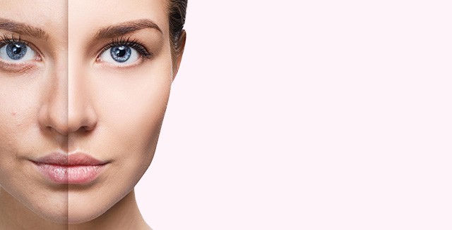 Microneedling